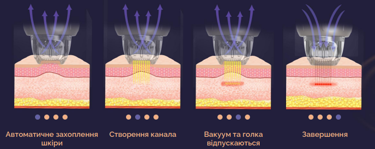 RF-ліфтинг-Луцьк